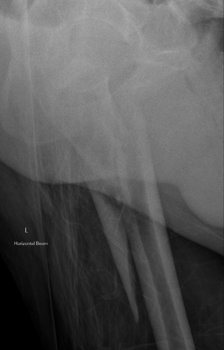 Subtrochanteric Fractures The Bone School